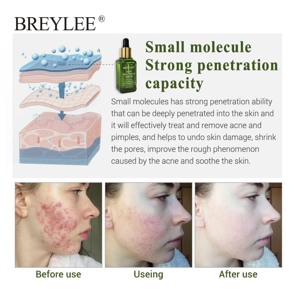 BREYLEE Anti-Akne Serum – Gesichtspflege gegen Akne & Pickel, mildert Aknenarben & Hautunreinheiten, mit Grüntee-Extrakt (30ml)
