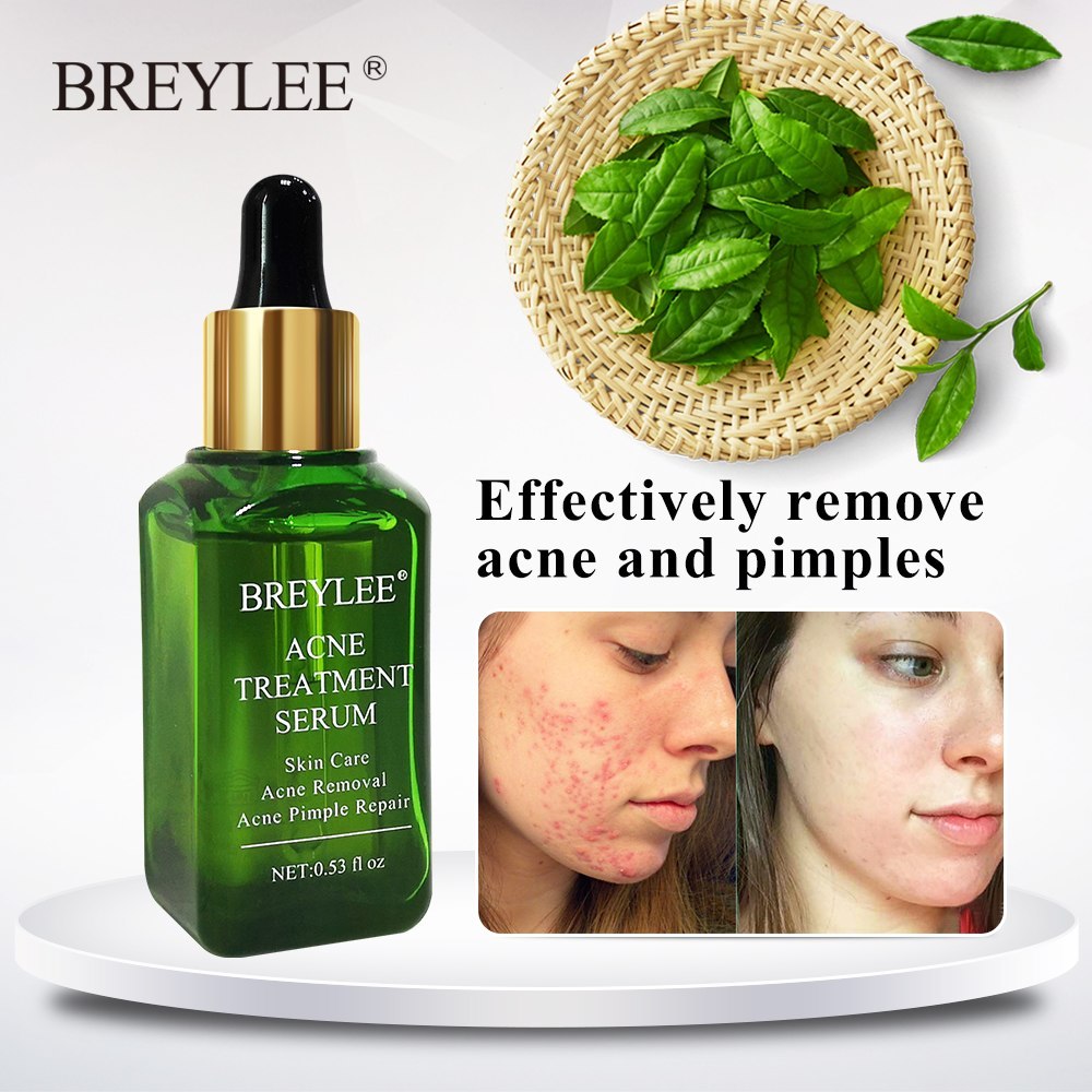 BREYLEE Anti-Akne Serum – Gesichtspflege gegen Akne & Pickel, mildert Aknenarben & Hautunreinheiten, mit Grüntee-Extrakt (30ml)