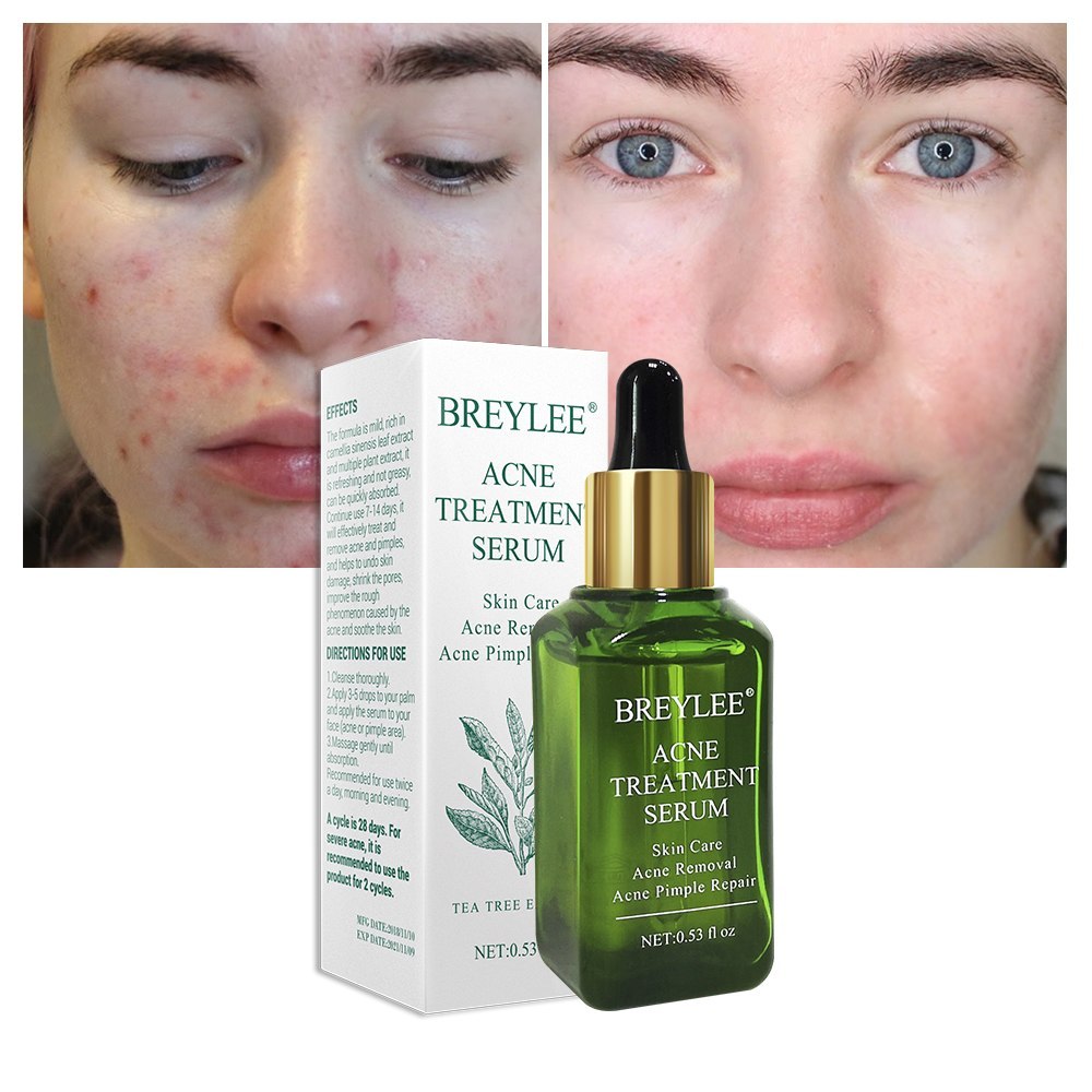 BREYLEE Anti-Akne Serum – Gesichtspflege gegen Akne & Pickel, mildert Aknenarben & Hautunreinheiten, mit Grüntee-Extrakt (30ml)